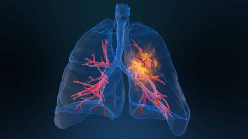 Akciğer Kanseri Belirtileri Nelerdir?
