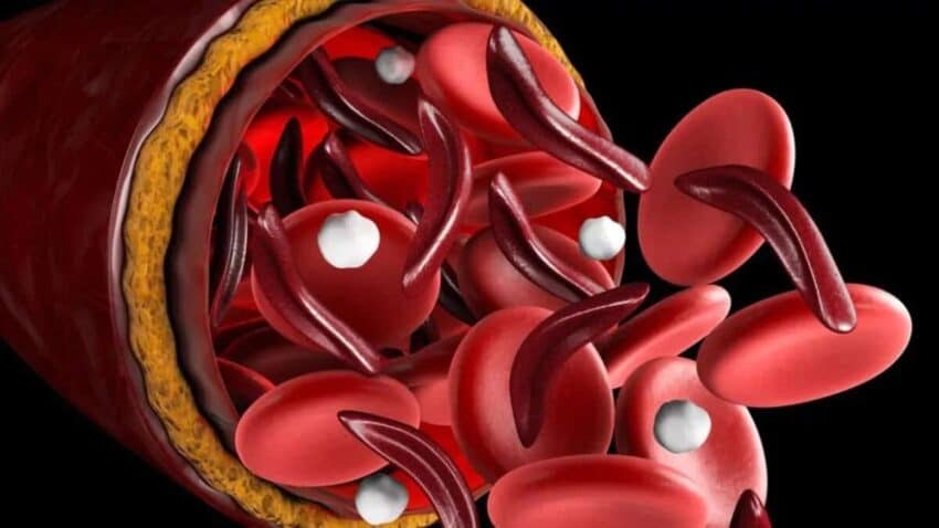Hemoglobin Nedir? Hemoglobin Kaç Olmalıdır?