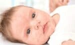 bebeklerin yuzundeki kizariklik nasil gecer optimized