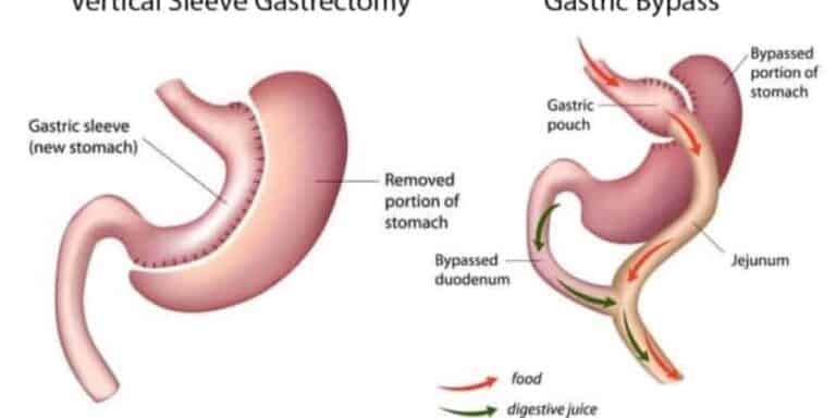 gastrik bypass ameliyati