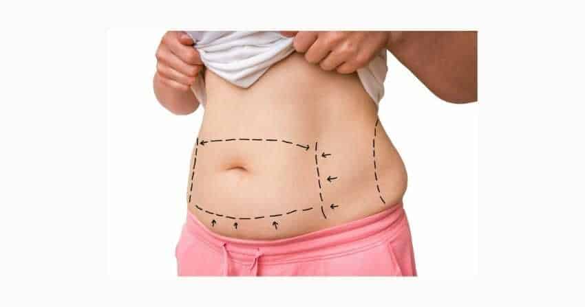 Liposuction Nedir? Retouch Body Clinic