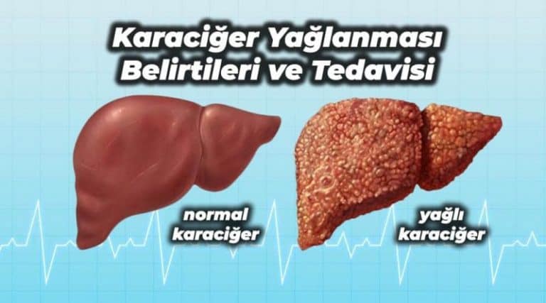 karaciger-yaglanmasi-belirtileri