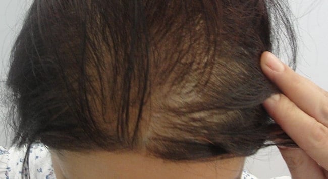Kadınlarda Saç Dökülmesi Nasıl Önlenir?