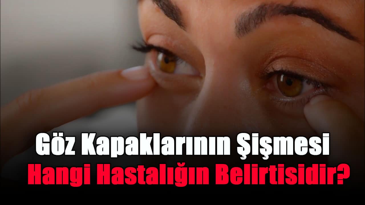 Vücudun şişmesi hangi hastalığın belirtisidir?