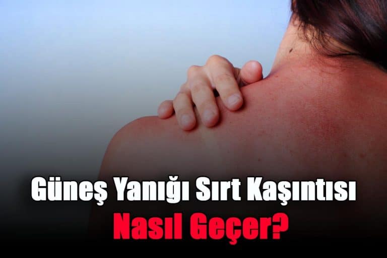 gunes-yanigi-sirt-kasintisi-nasil-gecer