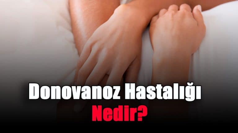 donovanoz-granuloma-inguinale-hastaligi-nedir