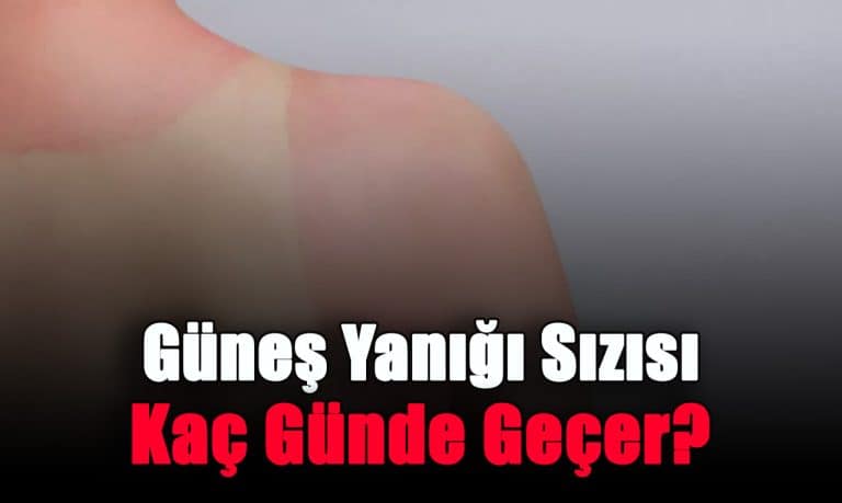 gunes-yanigi-sizisi-kac-gunde-gecer