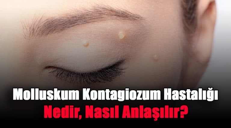 molluskum-kontagiozum-hastaligi-nedir-nasil-anlasilir