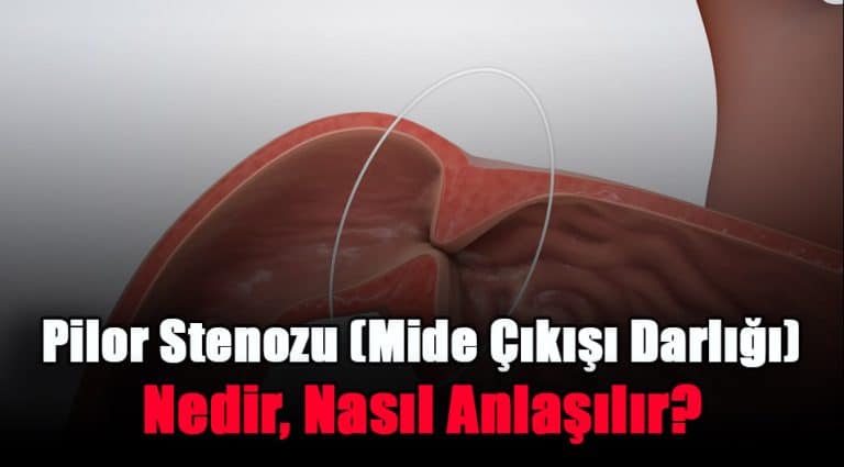 pilor-stenozu-mide-cikisi-darligi-nedir-nasil-anlasilir