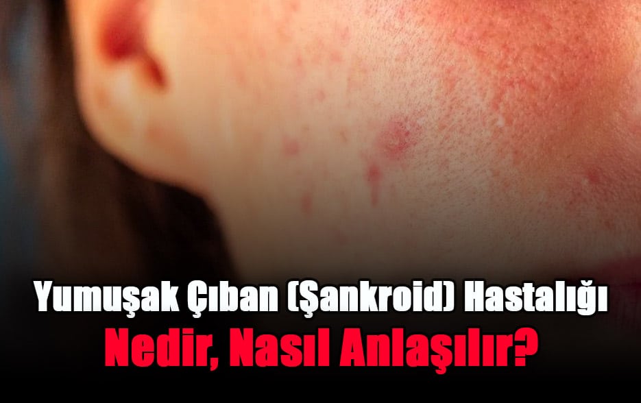 yumusak-ciban-sankroid-hastaligi-nedir-nasil-anlasilir