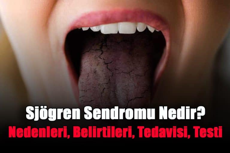 sjogren-sendromu-nedir-nedenleri-belirtileri-tedavisi-testi