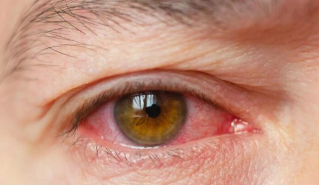 gözde kanlanma neden olur sık sık göz kanlanmasının sebepleri