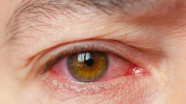 gözde kanlanma neden olur sık sık göz kanlanmasının sebepleri