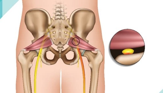 priformis sendromu belirtileri nelerdir