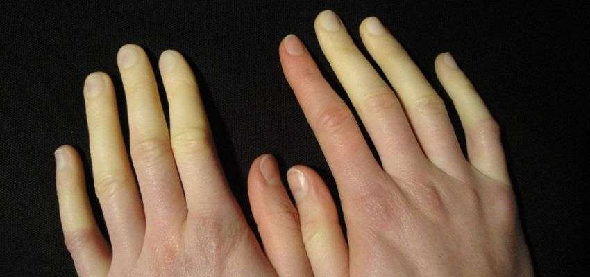 raynaud sendromu belirtileri nelerdir