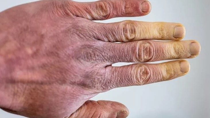 raynaud sendromu nedir nedenleri, belirtileri, tedavisi, testi