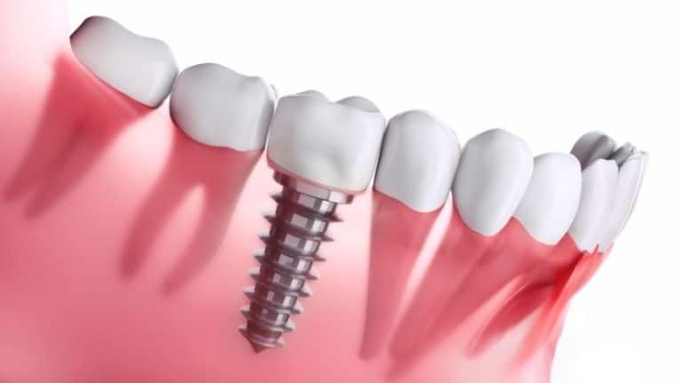 dental implant tedavisi