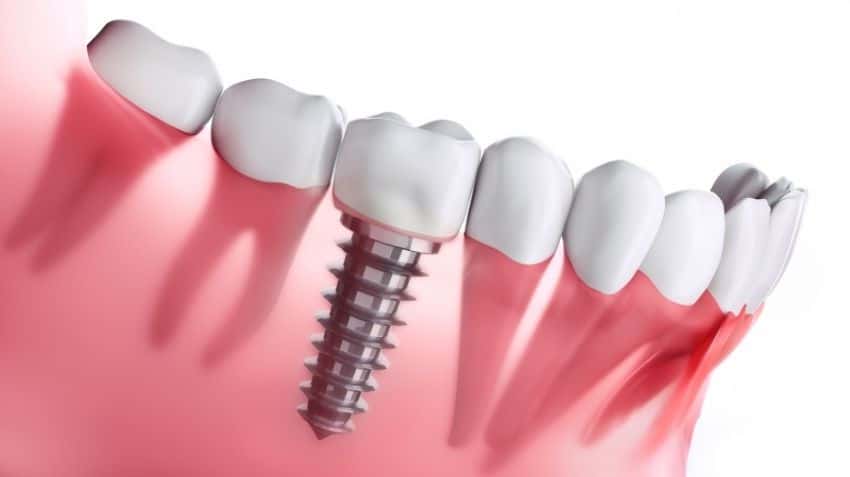 dental implant tedavisi