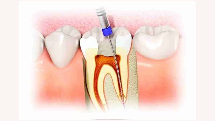 diş kanal tedavisi (1)