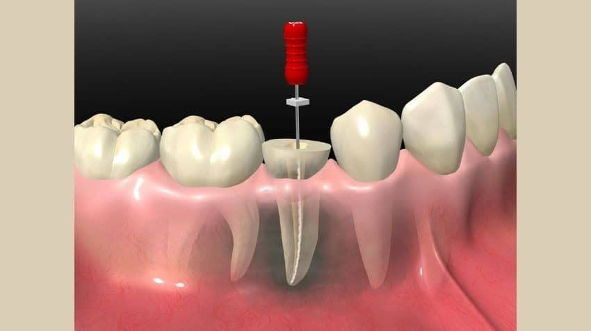 diş kanal tedavisi