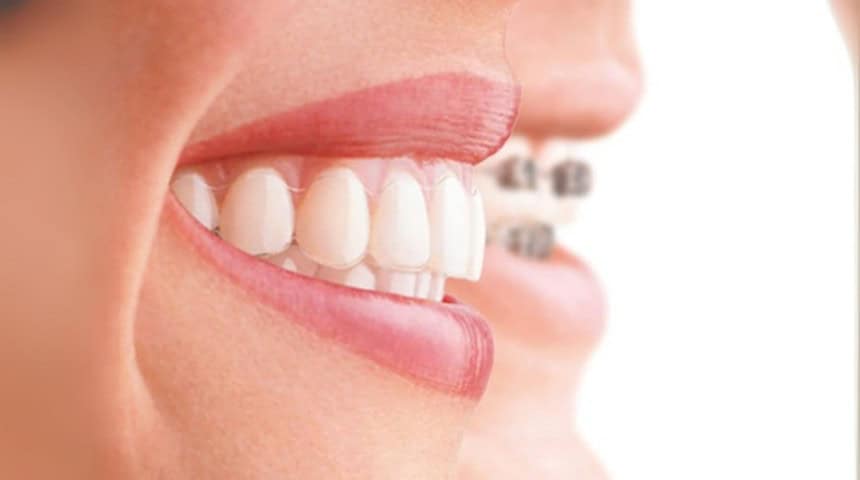 diş teli taktırmadan önce 2025 fiyatlarına göz atın! 1 diş teli