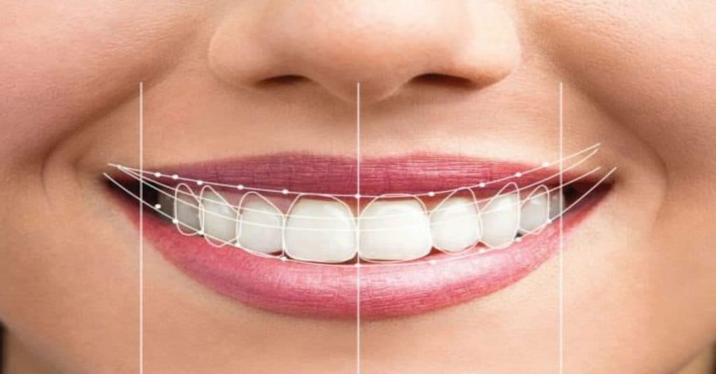 diş estetiği nedir? 3 dis-estetigi-nedir-3