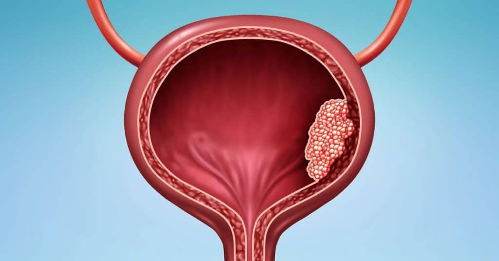 mesane-kanseri-tedavisi-2