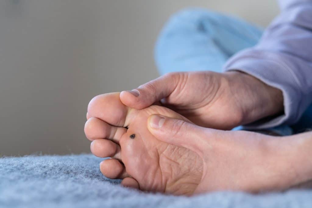 diyabetik ayak nedir? 2 diyabetik-ayak-nedir-2