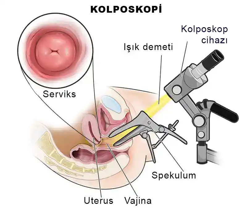 Kolposkopi Nedir? Rahim Ağzı Sağlığı İçin Neden Önemlidir? 2 kolposkopi-nasil-yapilir